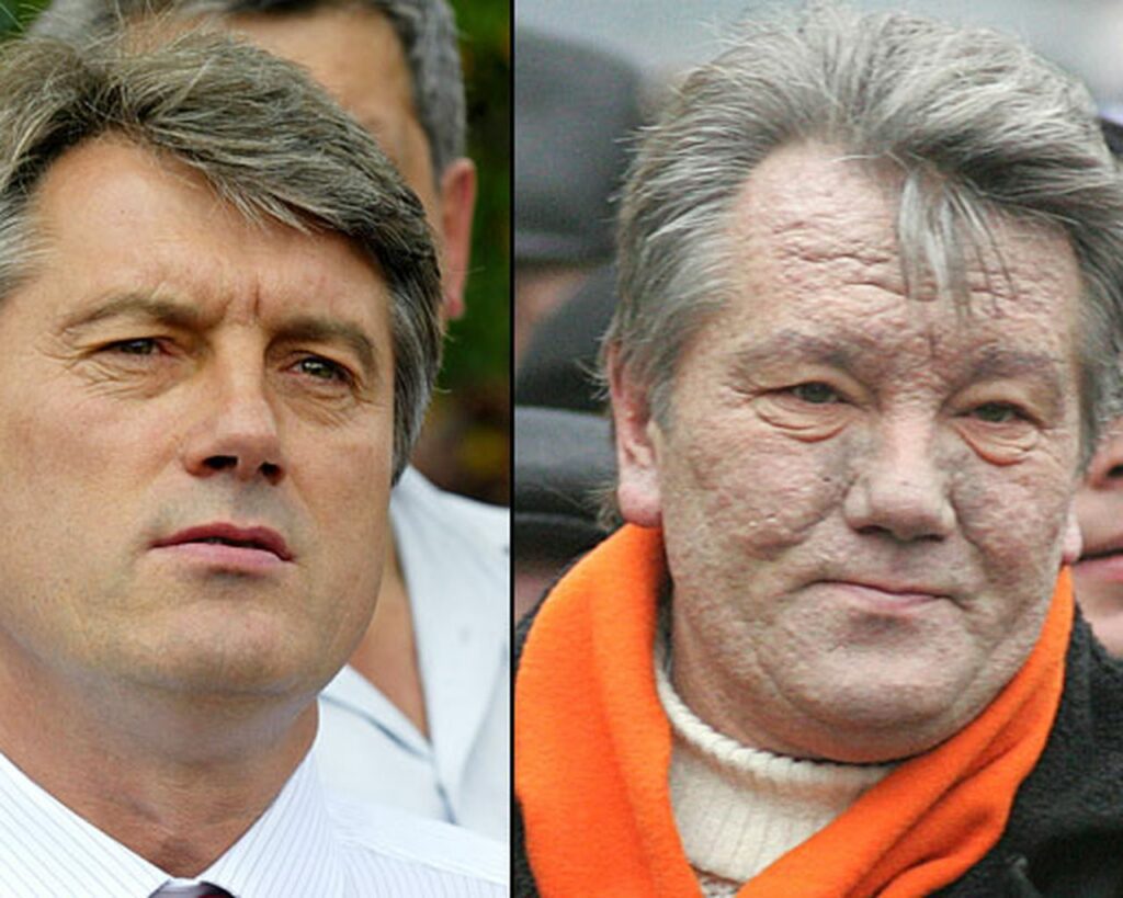 Former Ukrainian President Viktor Yushchenko (2005-2010), before and after dioxin poisoning. 